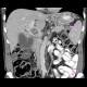 Thrombosis of portal vein: CT - Computed tomography